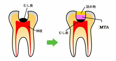 虫歯