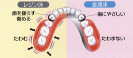 残存歯に優しい