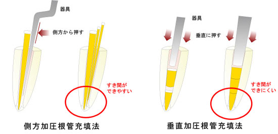 「側方加圧方式」と「垂直加圧方式」